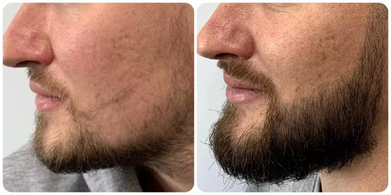 beard transplant result photos before after images Glasgow Scotland by Dr Bonaros
