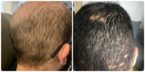 Patients with DUPA and alopecia areata are not good hair transplant candidates