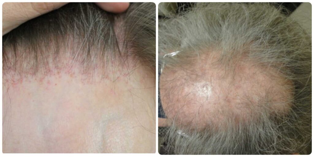 lichen planopilaris, frontal fibrosing alopecia patients are bad candidates for hair transplant surgery