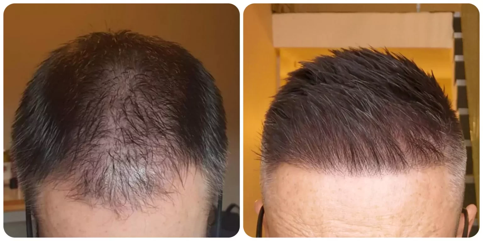 6 Months after the Mid-scalp Hair Transplant Procedure