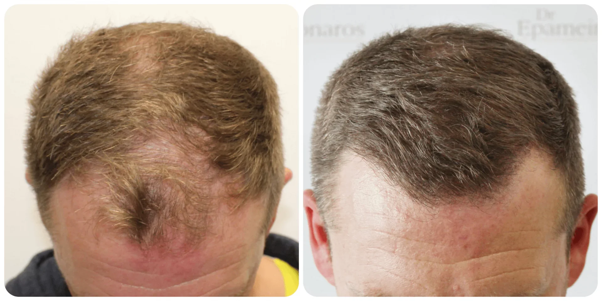 Mid-Scalp FUE Hair Transplant