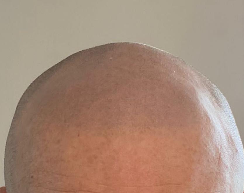 Scalp micropigmentation in the uk