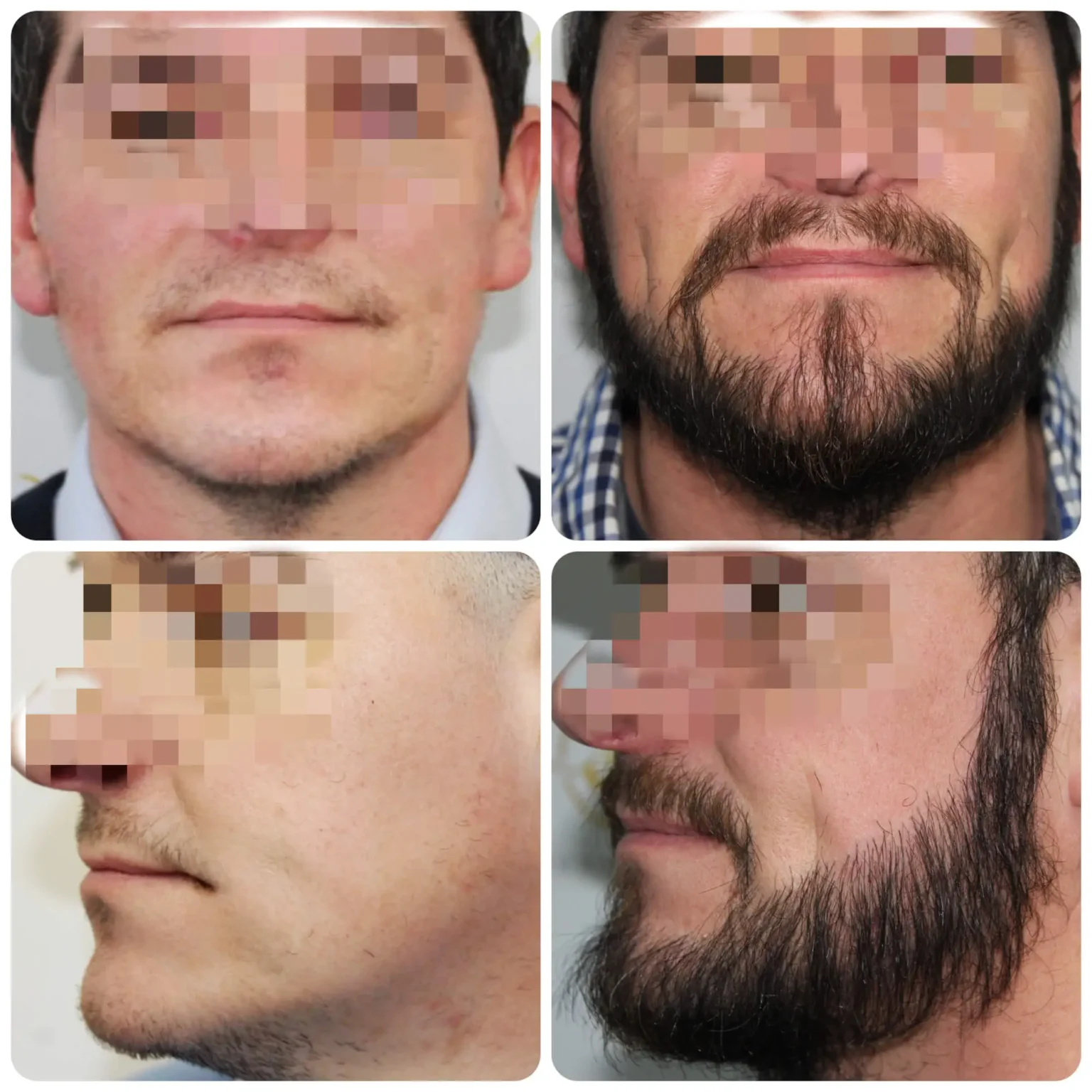 Beard Transplant Result by Dr. Bonaros