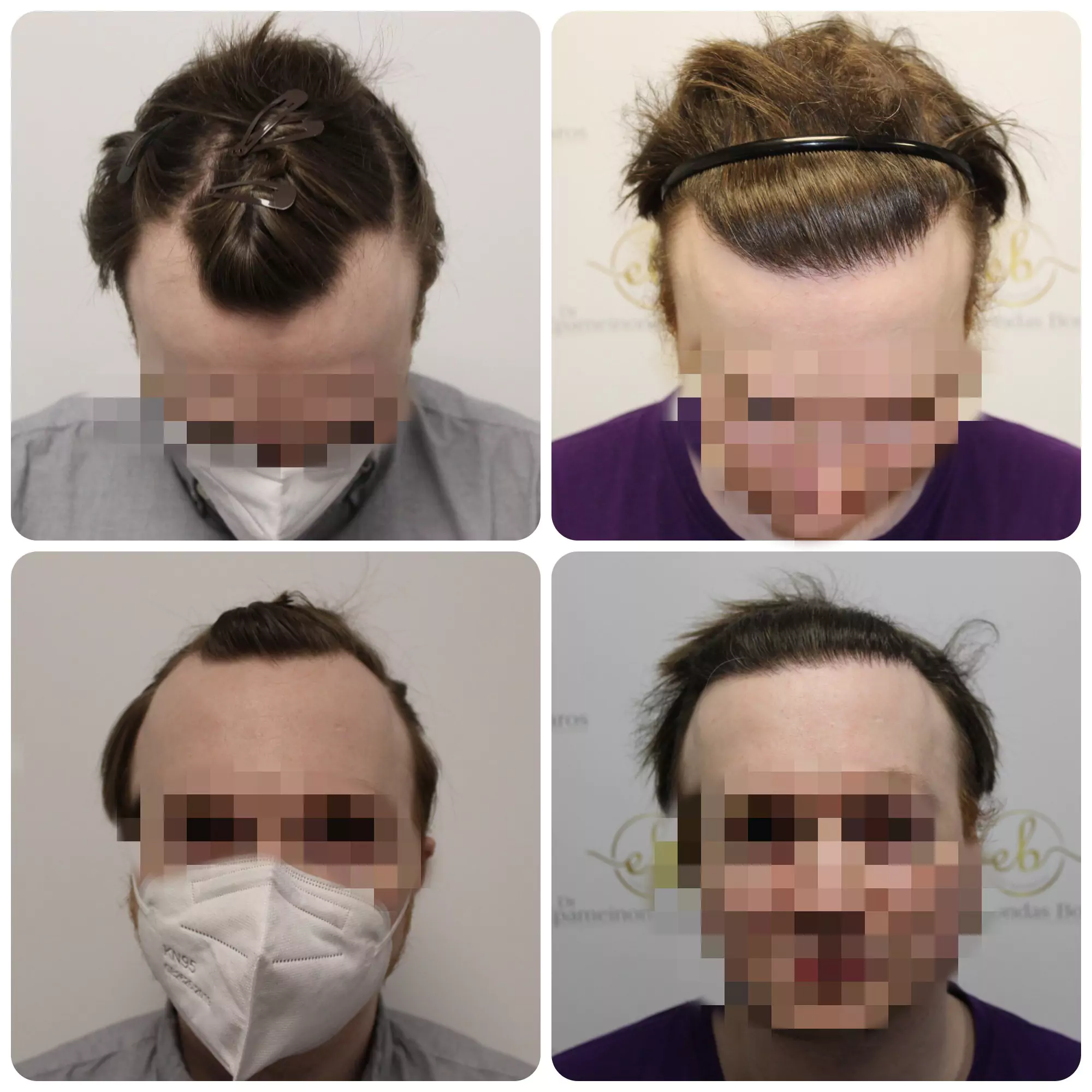 Receding Hairline Transplant Results