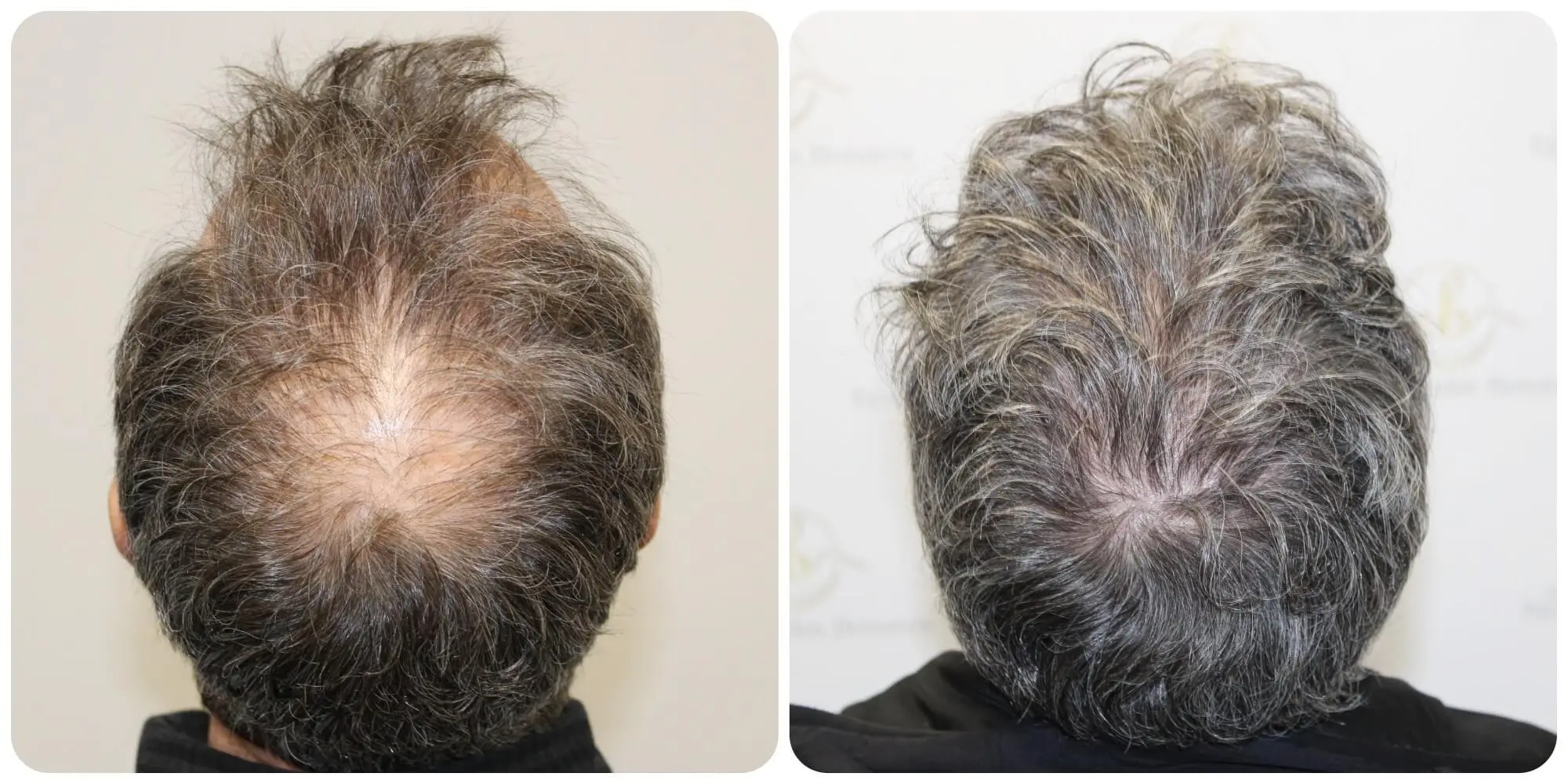 Frontal Hair Restoration
