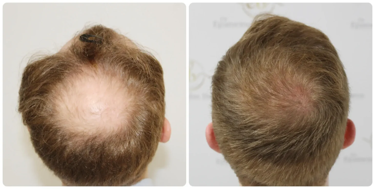 Before and After Results after using Minoxidil