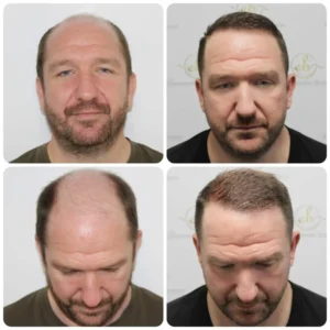 dr-bonaros-hair-transplant-glasgow-result-_2_-768x768