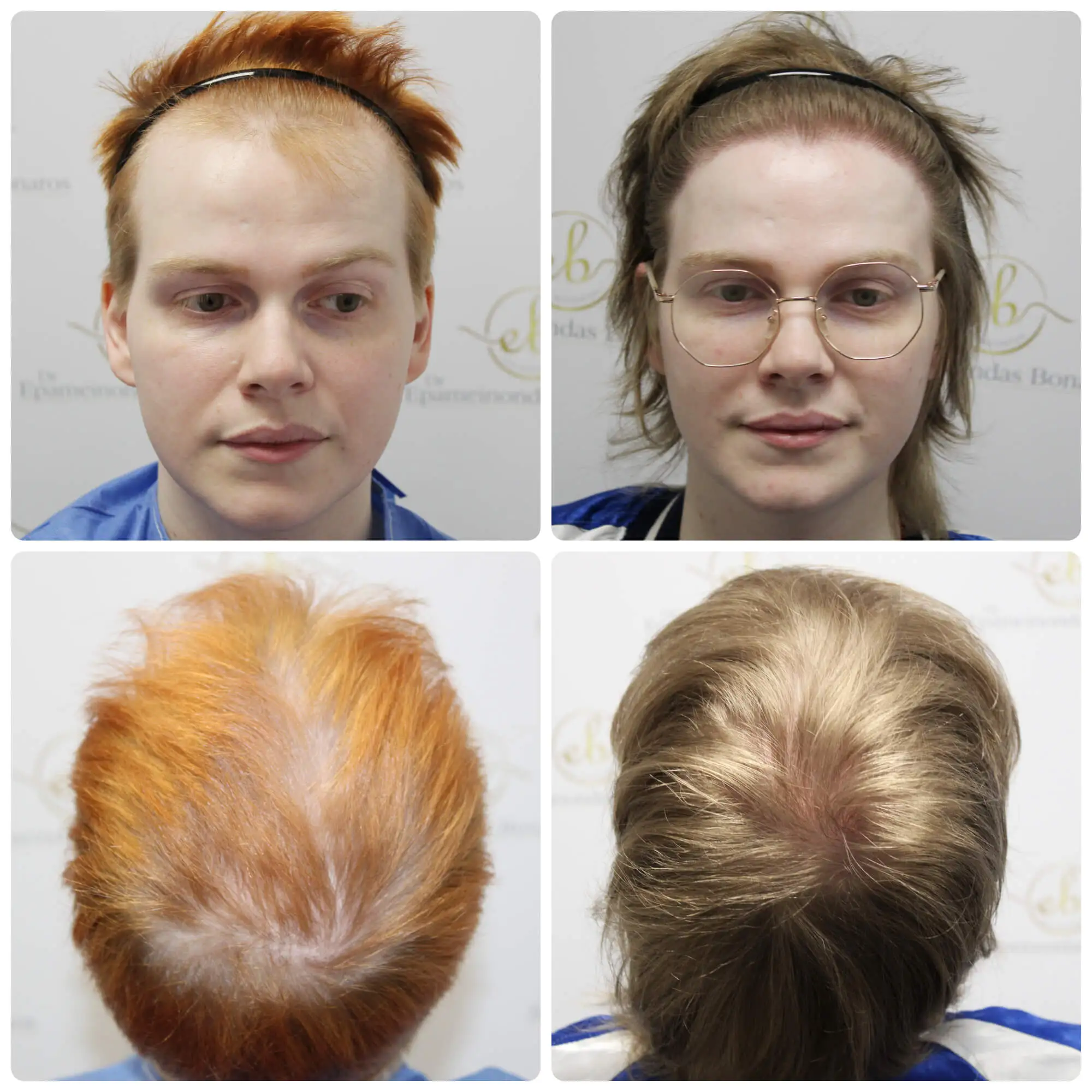 Transgender hair transplant
