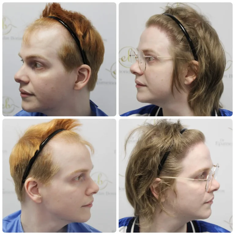Transgender hair transplant