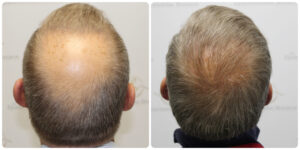 Crown Hair Transplant Result