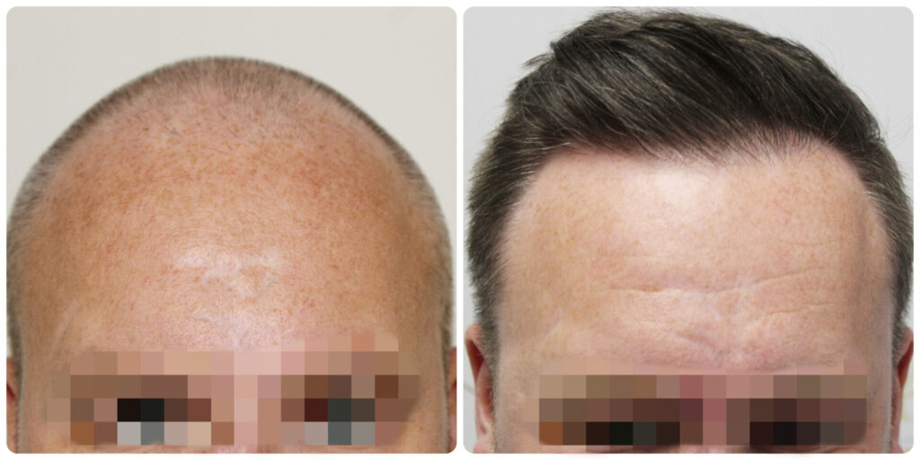 dr-bonaros-hair-transplant-glasgow-result (11) (1)