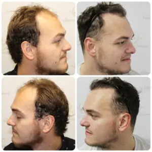 dr-bonaros-hair-transplant-glasgow-result (31)