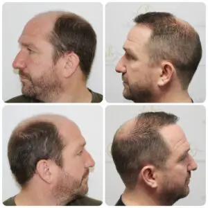 dr-bonaros-hair-transplant-glasgow-result (6)