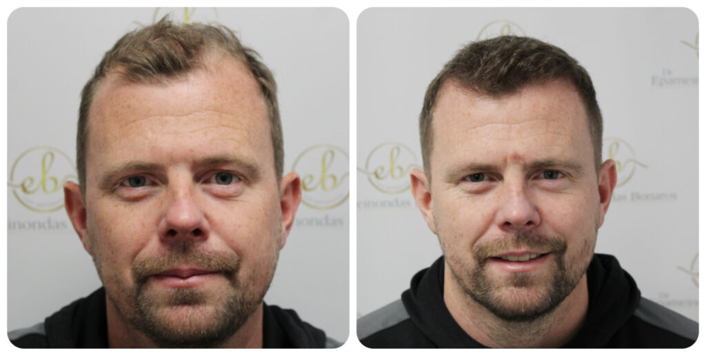 dr-bonaros-hair-transplant-glasgow-result (9) (1)