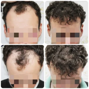 hairline hair transplant result by Dr Bonaros in Glasgow UK