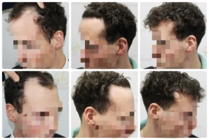 hairline hair transplant result by Dr Bonaros in Glasgow UK