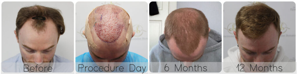 timeline-dr-bonaros-hair-transplant-glasgow-result
