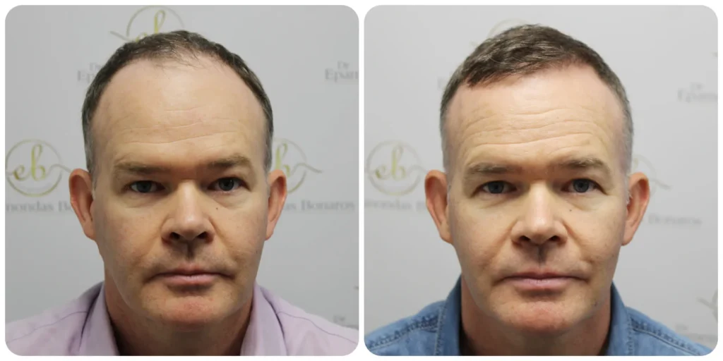 frontal third hair transplant result