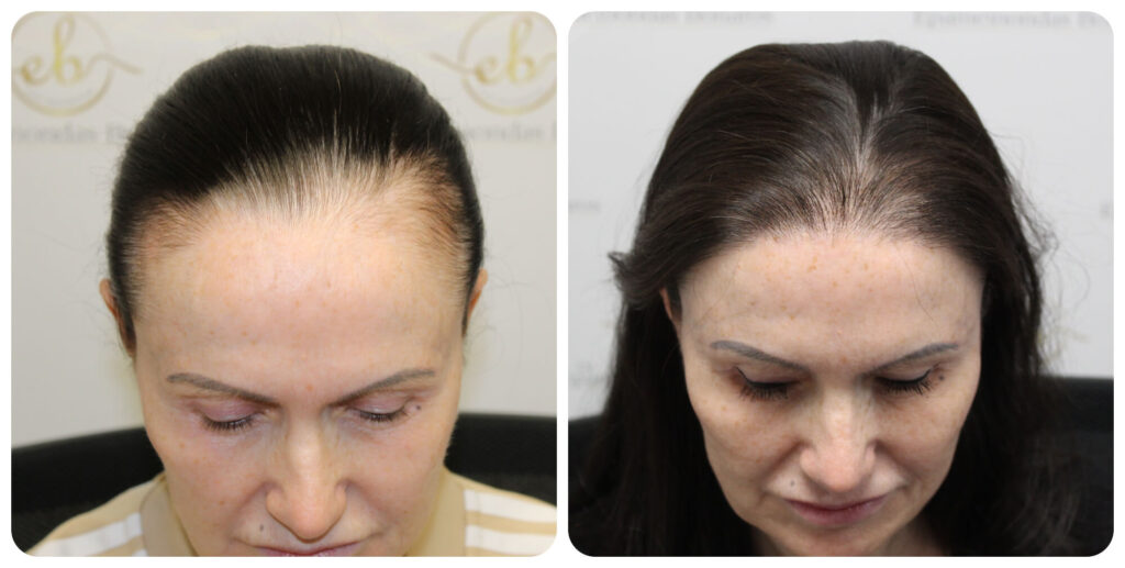 female-hairline-hair-transplant-dr-bonaros (5)