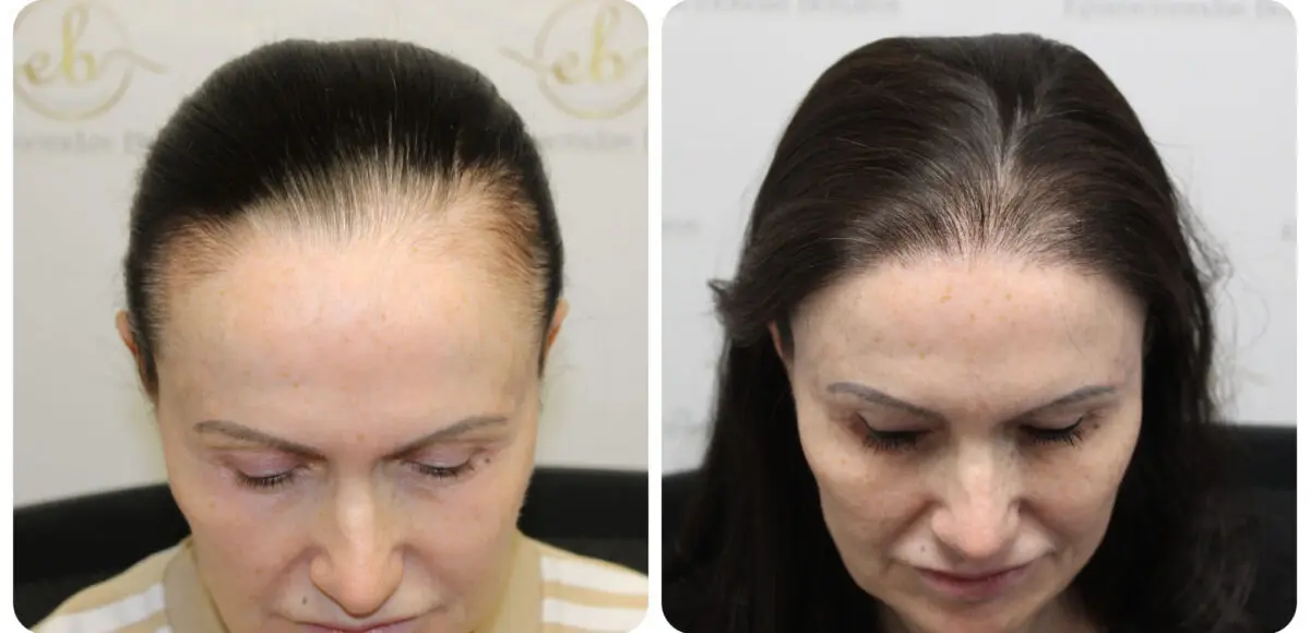 female-hairline-hair-transplant-dr-bonaros (5)