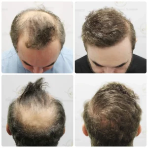 FUE hair Transplant