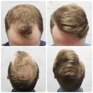 Copy of hair-transplant-12-months-result-glasgow-dr-bonaros (1)