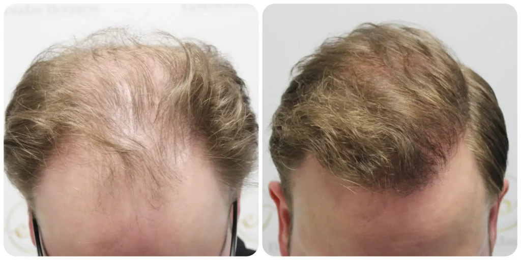 FUE hair transplant result