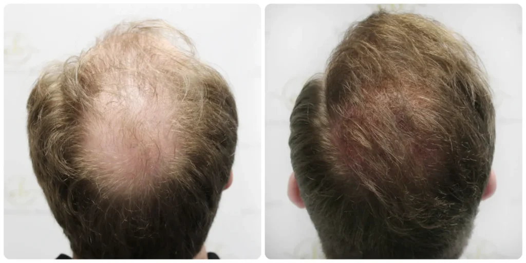 FUE crown hair transplant result