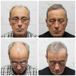 hair-transplant-dr-bonaros-scotland (4)