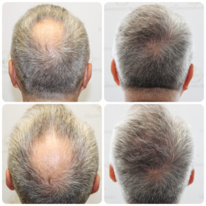 crown transplant before and after