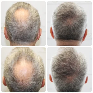 crown transplant before and after