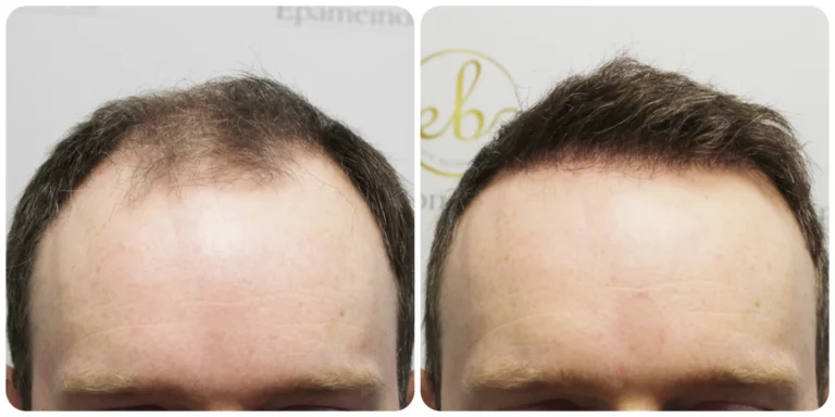 hairline transplant by Dr Bonaros in his clinic in Glasgow