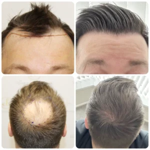 dr-bonaros-hair-transplant-glasgow