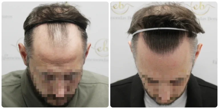 hairline transplant by Dr Bonaros in his clinic in Glasgow