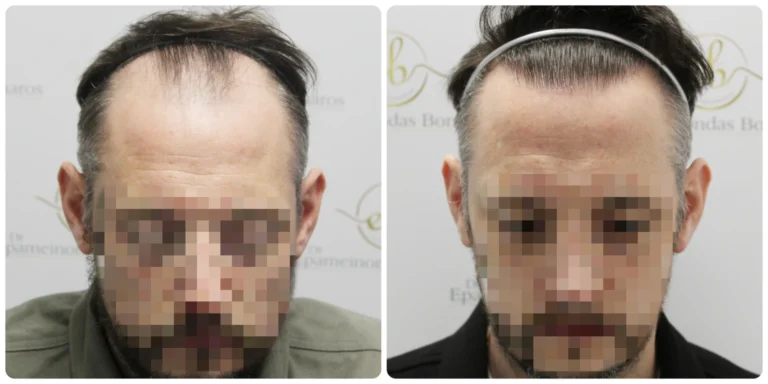 hairline transplant by Dr Bonaros in his clinic in Glasgow