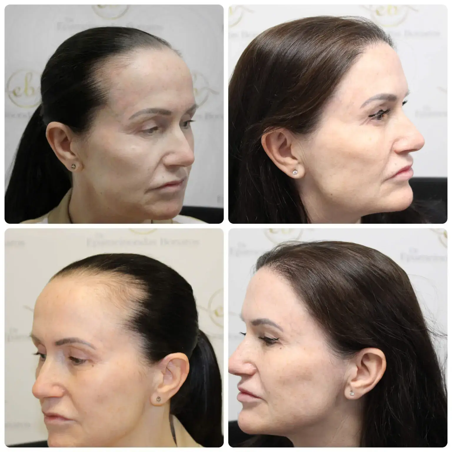 Before and after FUE hair transplant result performed by Dr Bonaros in Glasgow