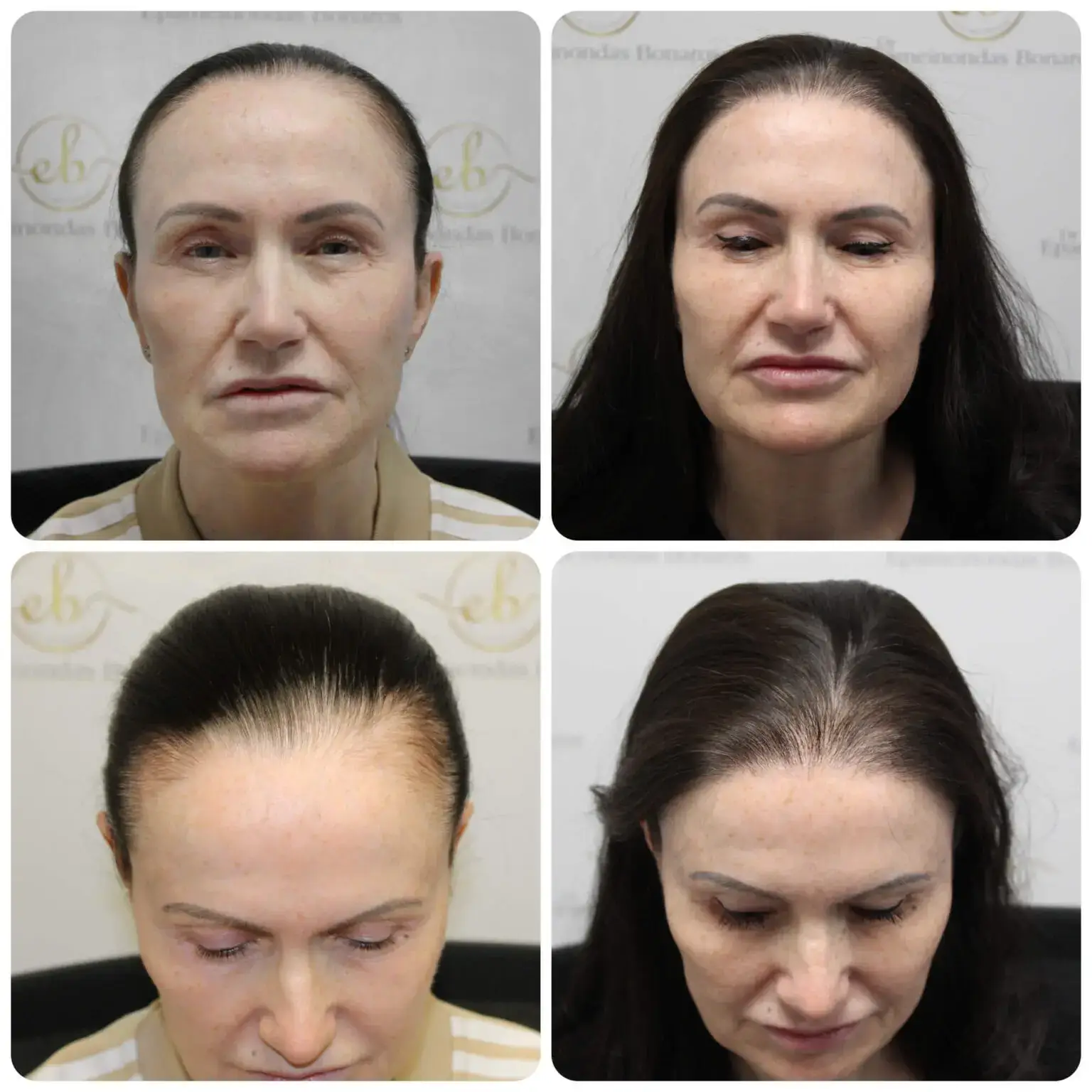 Before and after FUE hair transplant result performed by Dr Bonaros in Glasgow