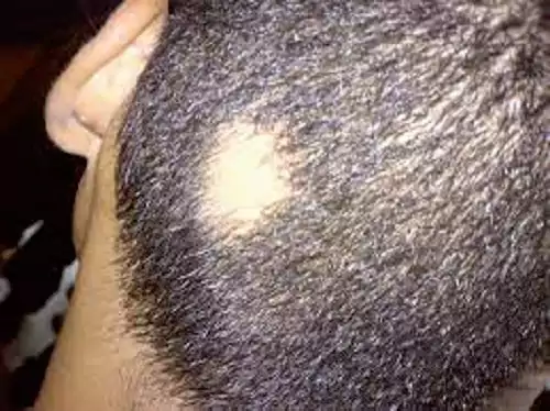 Circular patch of hair loss on the scalp typical of alopecia areata