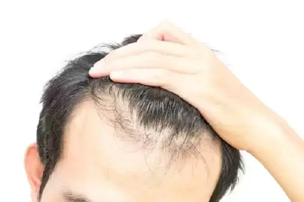 Receding hairline and crown thinning typical of androgenetic alopecia
