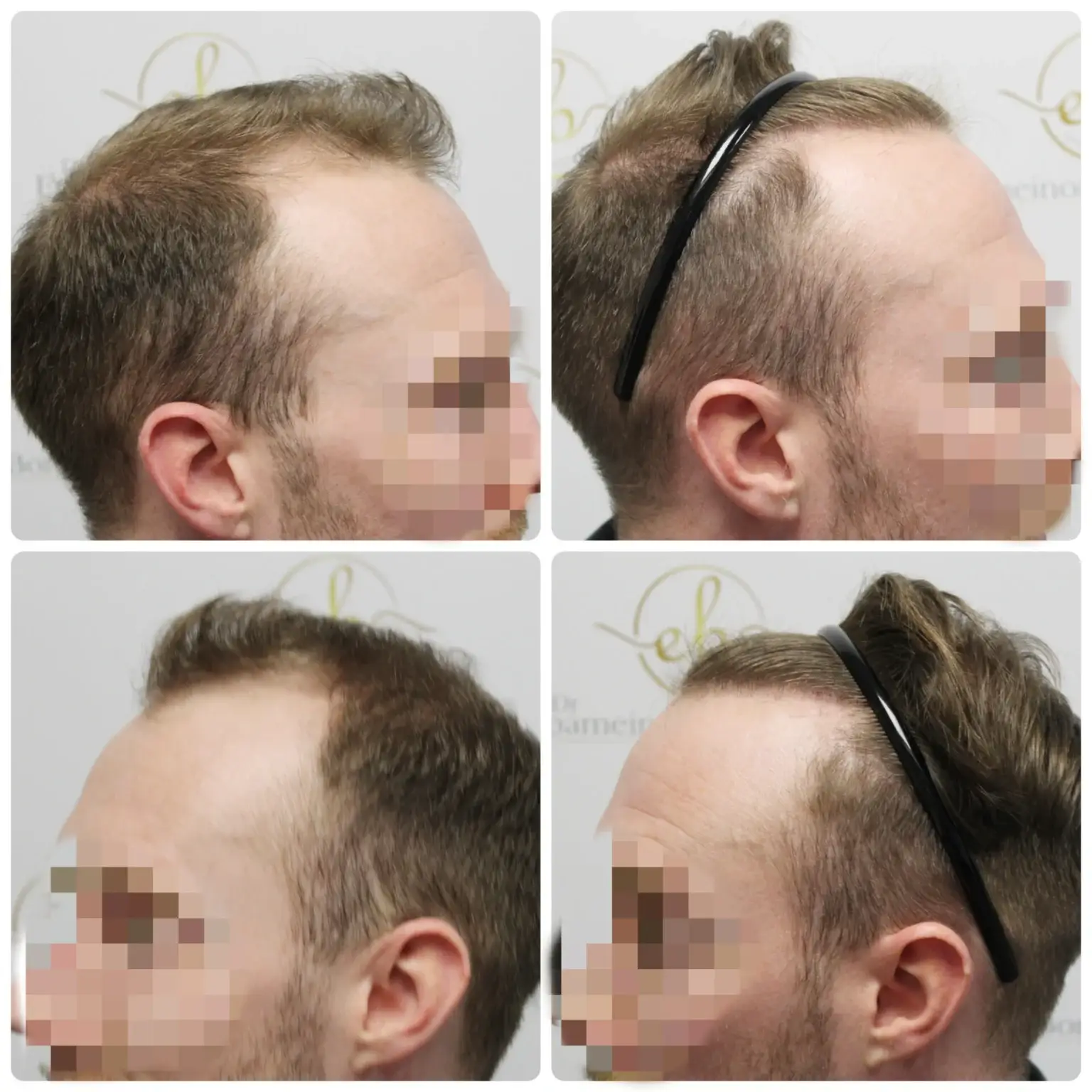 Before and after FUE hair transplant result performed by Dr Bonaros in Glasgow