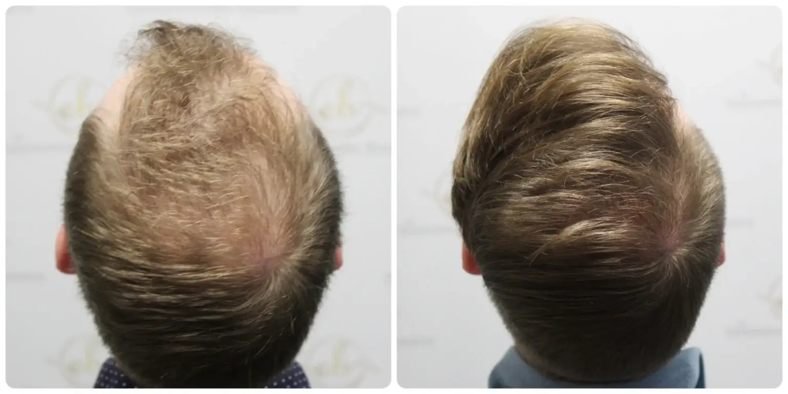 Before and after FUE hair transplant result performed by Dr Bonaros in Glasgow