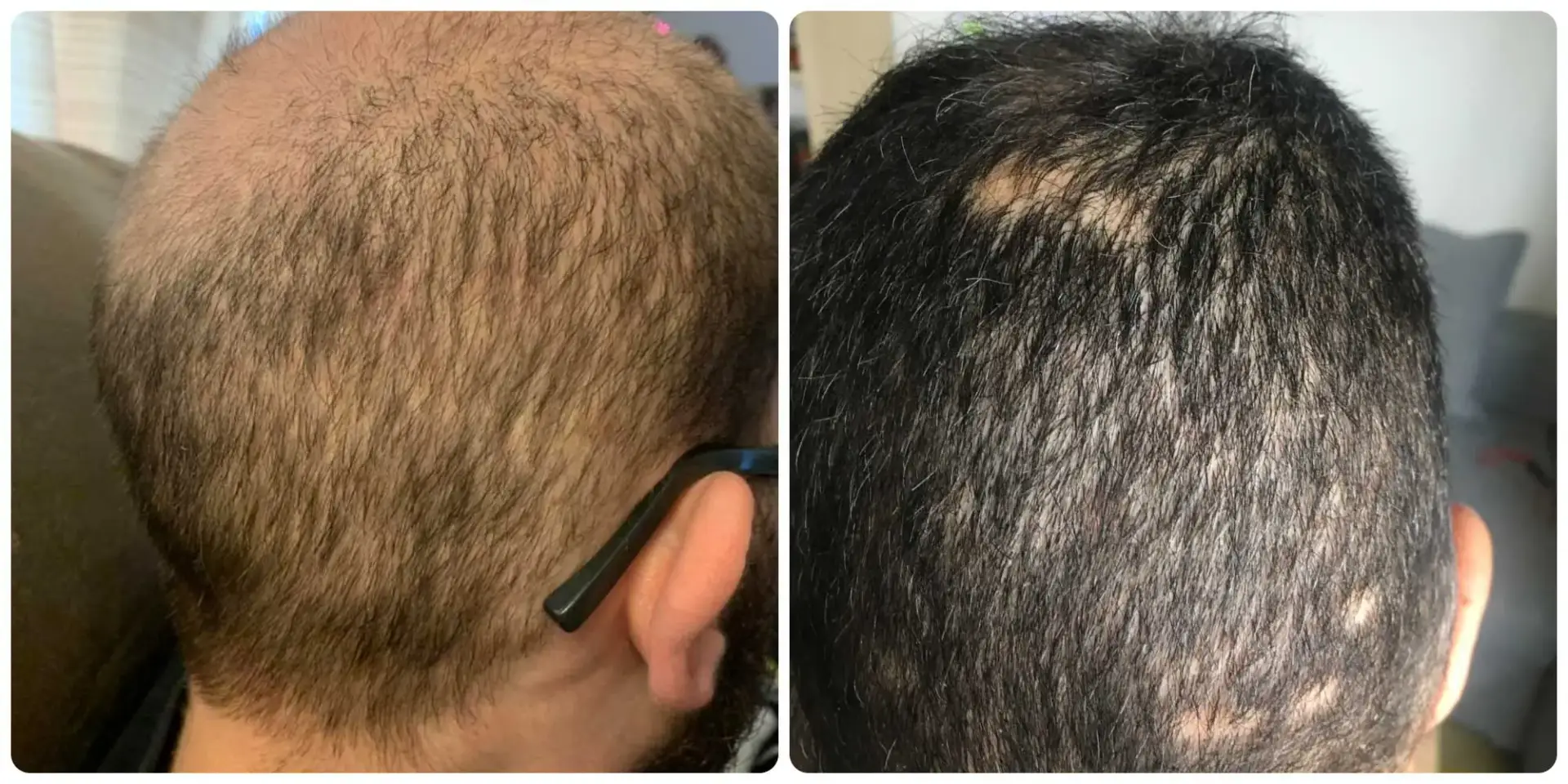Before and after comparison of male pattern hair loss at the crown