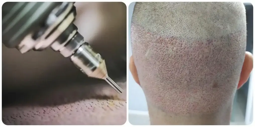 Illustration of the FUE follicular unit extraction method