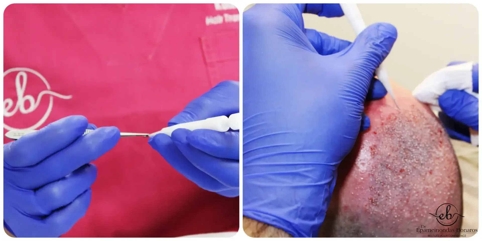 Direct hair implantation using sharp implanter pens