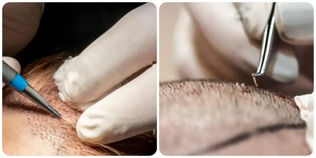 Creating recipient sites during an FUE hair transplant