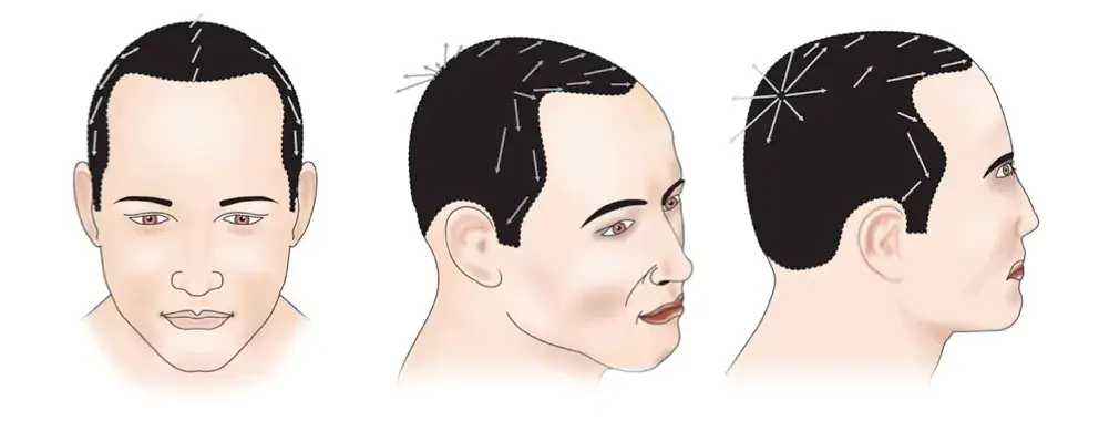 Close-up showing the direction and angle of transplanted grafts