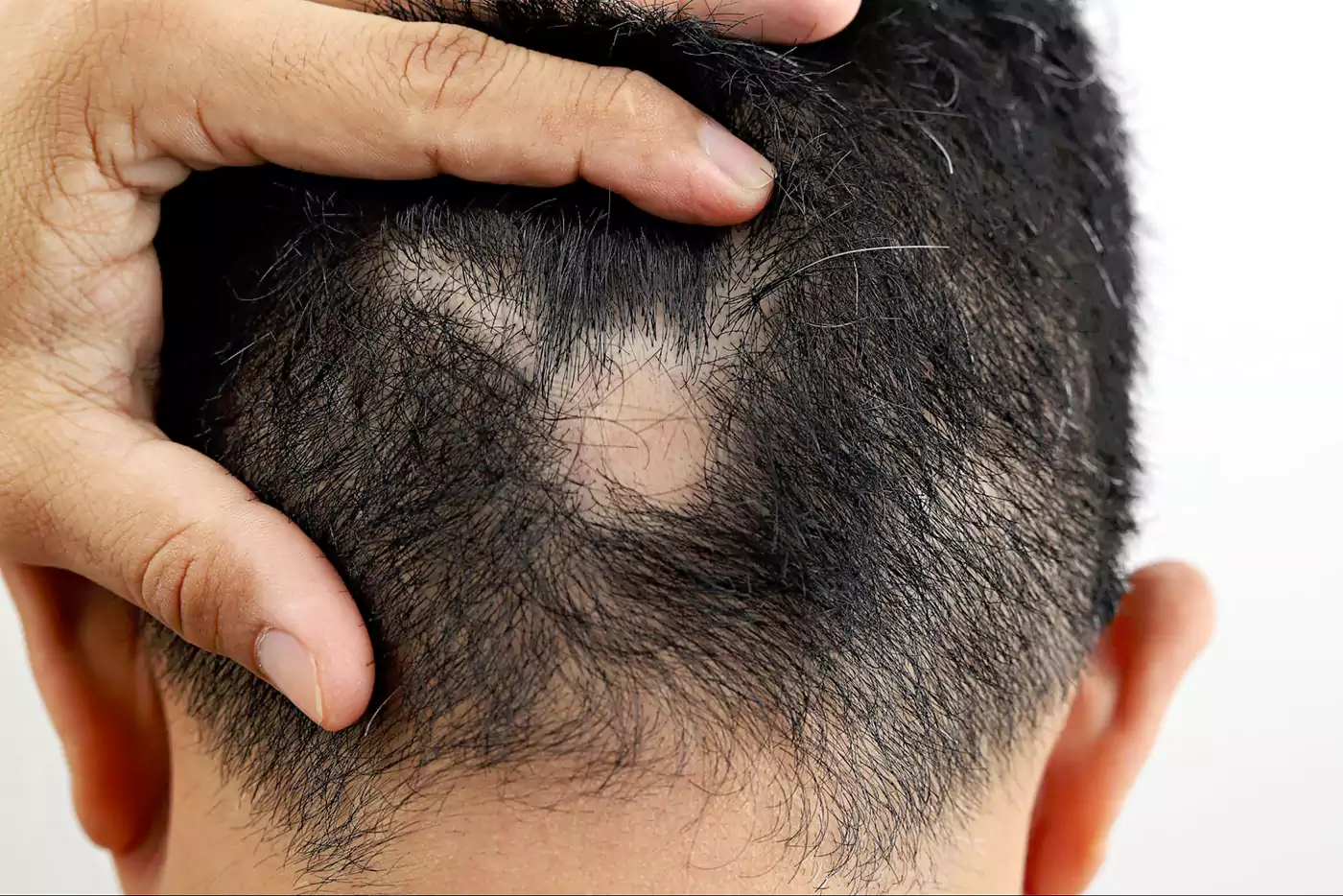 Hands parting dark hair to reveal patchy scalp hair loss