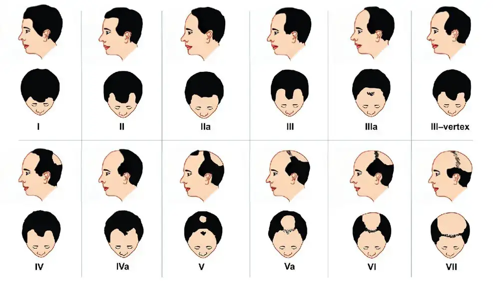 Norwood-Hamilton scale diagram showing the stages of male pattern hair loss