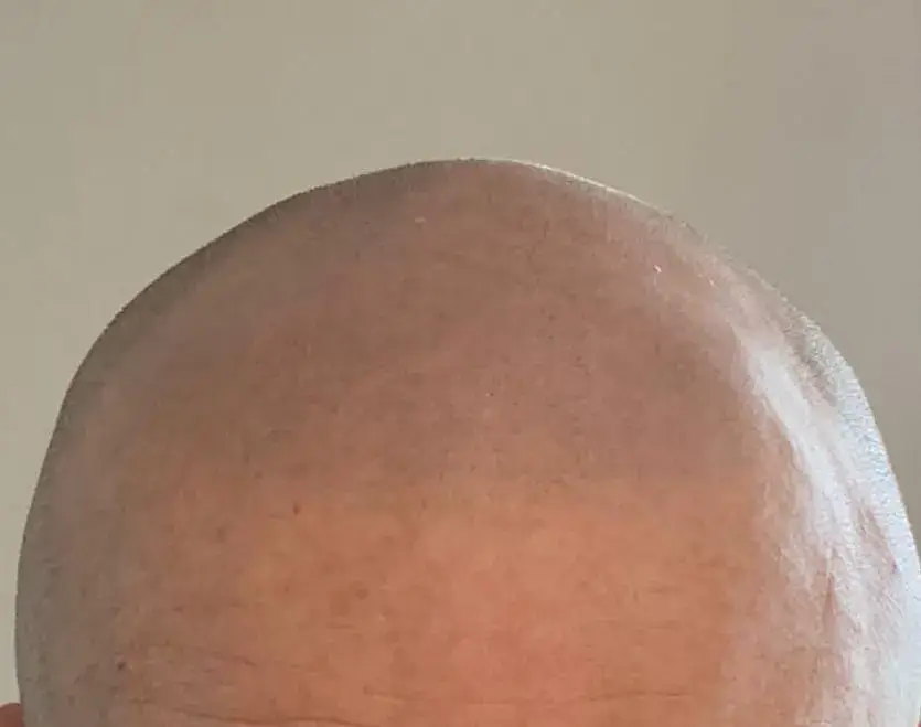 Shaved scalp treated with scalp micropigmentation