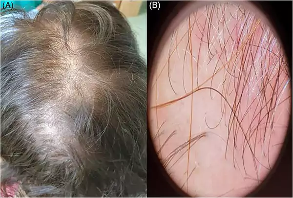 Scalp showing diffuse thinning consistent with telogen effluvium